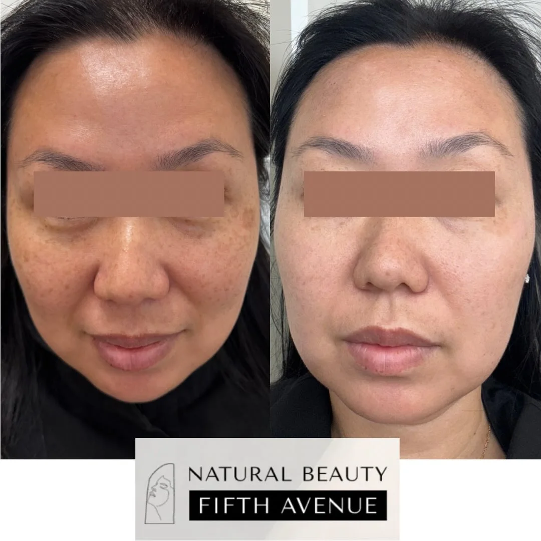 Before and after IPL treatment showing reduced skin discoloration and improved complexion